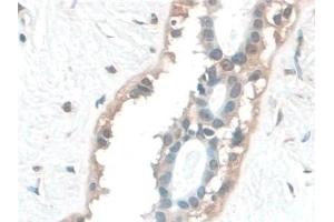 Detection of BANF1 in Human Breast cancer Tissue using Polyclonal Antibody to Barrier To Autointegration Factor 1 (BANF1)