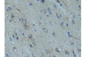 Detection of SMAD9 in Human Glioma Tissue using Polyclonal Antibody to SMAD family member 9 (SMAD9)