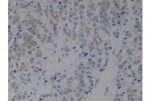 Detection of IkBb in Human Prostate Gland Cancer Tissue using Polyclonal Antibody to Inhibitory Subunit Of NF Kappa B Beta (IkBb)