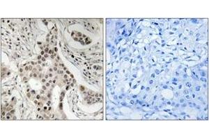 Immunohistochemistry analysis of paraffin-embedded human breast carcinoma, using NCoA2 (Phospho-Ser736) Antibody. (NCOA2 anticorps  (pSer736))