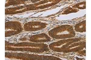 The image on the left is immunohistochemistry of paraffin-embedded Human colon cancer tissue using ABIN7191676(NOTCH4 Antibody) at dilution 1/30, on the right is treated with synthetic peptide. (NOTCH4 anticorps)