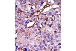 Formalin-fixed and paraffin-embedded human cancer tissue (breast carcinoma) reacted with the primary antibody, which was peroxidase-conjugated to the secondary antibody, followed by DAB staining.