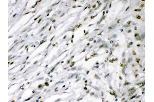 MEF2A was detected in paraffin-embedded sections of human meningeoma tissues using rabbit anti- MEF2A Antigen Affinity purified polyclonal antibody (Catalog # ) at 1 ?