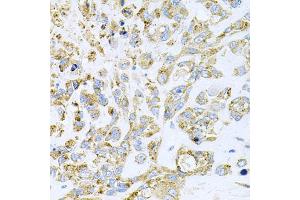 Immunohistochemistry of paraffin-embedded human lung cancer using HDAC3 antibody. (HDAC3 anticorps)