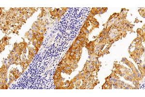 Detection of SPA2 in Human Lung cancer Tissue using Polyclonal Antibody to Surfactant Associated Protein A2 (SPA2) (SFTPA2 anticorps  (AA 21-114))