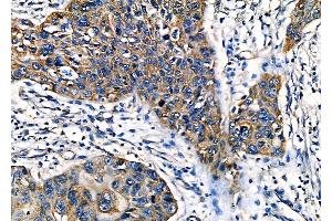 ABIN6262495 and ABIN6277945 at 1/100 staining Human esophageal cancer by IHC-P. (IGFBP2 anticorps  (C-Term))
