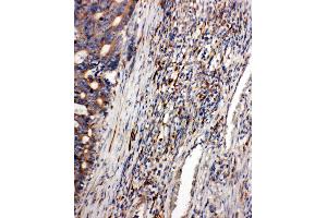 Anti-CD163 antibody,  IHC(P) IHC(P): Human Intestinal Cancer Tissue (CD163 anticorps  (C-Term))