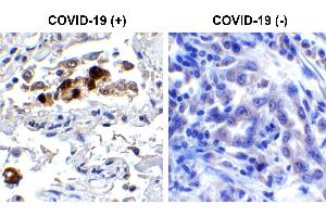 Immunohistochemistry Validation of SARS-CoV-2 (COVID-19) Spike RBD in COVID-19 Patient Lung Immunohistochemical analysis of paraffin-embedded COVID-19 patient lung tissue using anti- SARS-CoV-2 (COVID-19) Spike RBD antibody (ABIN6952968, 0. (SARS-CoV-2 Spike anticorps  (RBD))