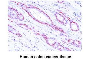 Paraffin embedded sections of human colon cancer tissue were incubated with anti-human MAT2A (1:50) for 2 hours at room temperature. (MAT2A anticorps)