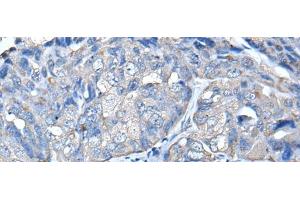 Immunohistochemistry of paraffin-embedded Human breast cancer tissue using PRKAR2A Polyclonal Antibody at dilution of 1:50(x200) (PRKAR2A anticorps)
