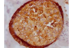 IHC image of ABIN7127461 diluted at 1:100 and staining in paraffin-embedded human breast cancer performed on a Leica BondTM system.