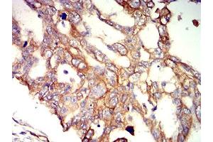 Immunohistochemical analysis of paraffin-embedded ovarian cancer tissues using APC2 mouse mAb with DAB staining.
