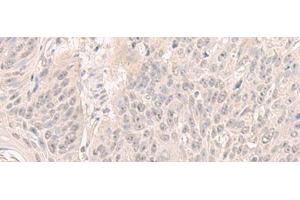 Immunohistochemistry of paraffin-embedded Human esophagus cancer tissue using HENMT1 Polyclonal Antibody at dilution of 1:30(x200) (HENMT1 anticorps)