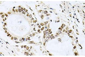 Immunohistochemistry of paraffin-embedded Human gastric cancer using MCL1 Polyclonal Antibody at dilution of 1:100 (40x lens). (MCL-1 anticorps)