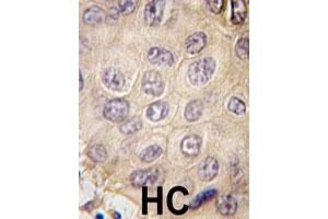Formalin-fixed and paraffin-embedded human hepatocellular carcinoma reacted with EDA polyclonal antibody  , which was peroxidase-conjugated to the secondary antibody, followed by DAB staining. (Ectodysplasin A anticorps  (N-Term))