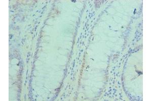 Immunohistochemistry of paraffin-embedded human colon cancer using ABIN7143052 at dilution of 1:100 (BAF53A anticorps  (AA 1-280))
