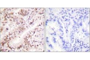Immunohistochemistry analysis of paraffin-embedded human lung carcinoma, using Estrogen Receptor-alpha (Phospho-Tyr537) Antibody. (Estrogen Receptor alpha anticorps  (pTyr537))
