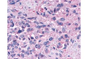 Anti-NPY4R / PPYR1 antibody IHC of human Brain, Glioblastoma. (NPY4R anticorps  (Extracellular Domain))