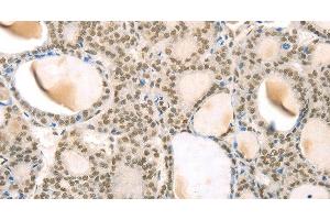 Immunohistochemistry of paraffin-embedded Human thyroid cancer using TSPAN13 Polyclonal Antibody at dilution of 1:35 (TSPAN13 anticorps)