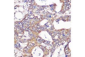 Immunohistochemistry of paraffin-embedded Human colon carcinoma using TUBGCP6 Rabbit pAb (ABIN7271055) at dilution of 1:100 (40x lens). (GCP6 anticorps  (AA 600-900))