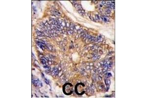 Formalin-fixed and paraffin-embedded human colon carcinoma tissue reacted with LDLR antibody (N-term) (ABIN392553 and ABIN2842100) , which was peroxidase-conjugated to the secondary antibody, followed by DAB staining.