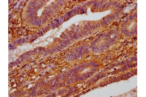 IHC image of ABIN7176036 diluted at 1:400 and staining in paraffin-embedded human colon cancer performed on a Leica BondTM system.