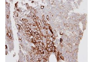 IHC-P Image Immunohistochemical analysis of paraffin-embedded D54MG xenograft, using KRT6A, antibody at 1:100 dilution. (KRT6A anticorps)
