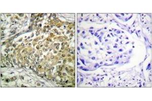 Immunohistochemistry analysis of paraffin-embedded human lung carcinoma tissue, using p53 (Acetyl-Lys379) Antibody. (p53 anticorps  (acLys381))