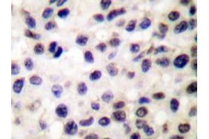 Immunohistochemistry analyzes of Stat5b antibody in paraffin-embedded human colon carcinoma tissue. (STAT5B anticorps)