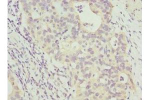 Immunohistochemistry of paraffin-embedded human bladder cancer using ABIN7144072 at dilution of 1:100 (ANAPC2 anticorps  (AA 1-230))