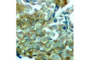 Immunohistochemistry (IHC) image for anti-Epidermal Growth Factor Receptor (EGFR) (pTyr1172) antibody (ABIN3019839) (EGFR anticorps  (pTyr1172))