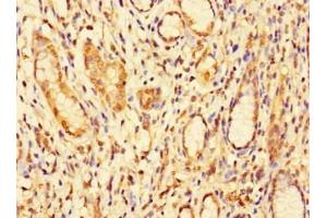 Immunohistochemistry of paraffin-embedded human gastric cancer using ABIN7157917 at dilution of 1:100