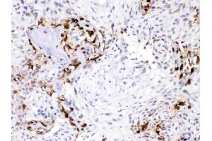 CA3 was detected in paraffin-embedded sections of human osteosarcoma tissues using rabbit anti- CA3 Antigen Affinity purified polyclonal antibody (Catalog # ) at 1 µg/mL.