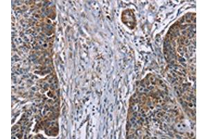 The image on the left is immunohistochemistry of paraffin-embedded Human esophagus cancer tissue using ABIN7191114(IQCJ Antibody) at dilution 1/30, on the right is treated with synthetic peptide. (IQCJ anticorps)