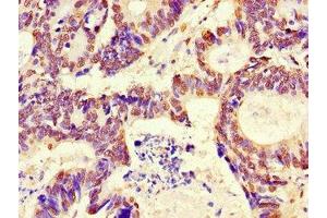 Immunohistochemistry of paraffin-embedded human colon cancer using ABIN7167735 at dilution of 1:100 (RFPL4B anticorps  (AA 1-263))