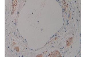 Detection of NT-ProANP in Human Stomach cancer Tissue using Polyclonal Antibody to N-Terminal Pro-Atrial Natriuretic Peptide (NT-ProANP)