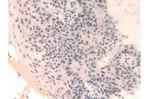 IHC-P analysis of Human Skin Cancer Tissue, with DAB staining. (FAM19A3 anticorps  (AA 44-130))