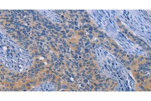 Immunohistochemistry of paraffin-embedded Human cervical cancer tissue using NEK8 Polyclonal Antibody at dilution 1:30 (NEK8 anticorps)