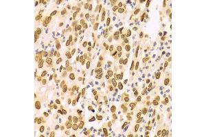 Immunohistochemistry of paraffin-embedded Human gastric cancer using LMNA antibody at dilution of 1:100 (x400 lens).