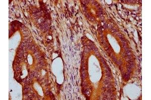 IHC image of ABIN7172139 diluted at 1:400 and staining in paraffin-embedded human colon cancer performed on a Leica BondTM system.