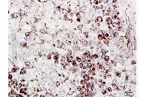 Formalin-fixed and paraffin embedded mouse melanoma labeled with Anti-Melanoma HMB45/Melanoma/Melan-A/MART-1 Polyclonal Antibody, Unconjugated (ABIN724190) at 1:200 followed by conjugation to the secondary antibody and DAB staining. (MLANA anticorps  (AA 51-118))