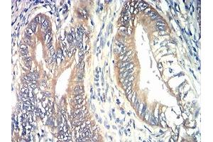 Immunohistochemical analysis of paraffin-embedded rectum cancer tissues using TIA1 mouse mAb with DAB staining. (TIA1 anticorps  (AA 1-215))