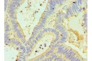Immunohistochemistry of paraffin-embedded human colon cancer using ABIN7154304 at dilution of 1:100 (GORASP1 anticorps  (AA 221-440))