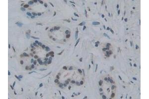 Detection of TOR1A in Human Pancreatic cancer Tissue using Polyclonal Antibody to Torsin 1A (TOR1A)