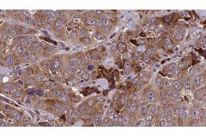 ABIN6273843 at 1/100 staining Human liver cancer tissue by IHC-P. (DRD5 anticorps  (N-Term))