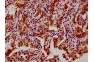 IHC image of ABIN7127701 diluted at 1:100 and staining in paraffin-embedded human lung cancer performed on a Leica BondTM system. (Recombinant HSP27 anticorps  (pSer82))