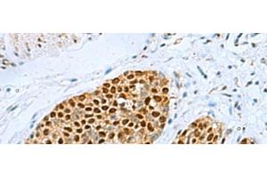 Immunohistochemistry of paraffin-embedded Human esophagus cancer tissue using TFAP4 Polyclonal Antibody at dilution of 1:70(x200) (TFAP4 anticorps)