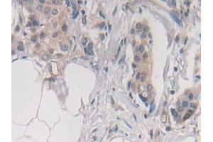 Detection of STX2 in Human Breast cancer Tissue using Polyclonal Antibody to Syntaxin 2 (STX2) (STX2 anticorps  (AA 8-262))