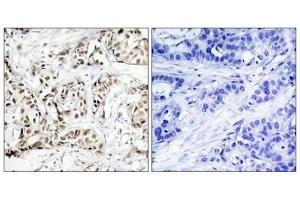 Immunohistochemical analysis of paraffin-embedded human breast carcinoma tissue using SAPK/JNK(Phospho-Thr183) Antibody(left) or the same antibody preincubated with blocking peptide(right). (JNK2 anticorps  (pThr183))