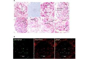 Glomerular tissue factor expression in biopsy tissues.